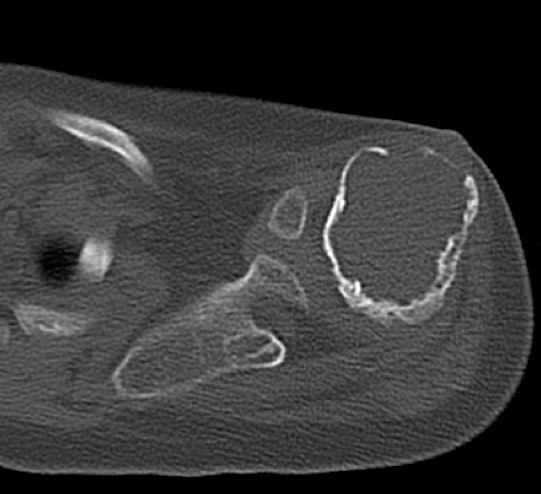 Figure 5 for case Myositis ossificans